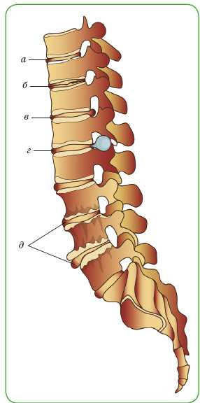 Заболевания межпозвонковых дисков: а — нормальный диск; б — дегенеративный диск; в — выпячивание (протрузия) диска; г — грыжа диска; д — костные разрастания (остеофиты)