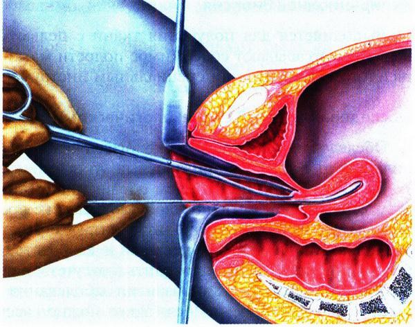 Зондирование матки