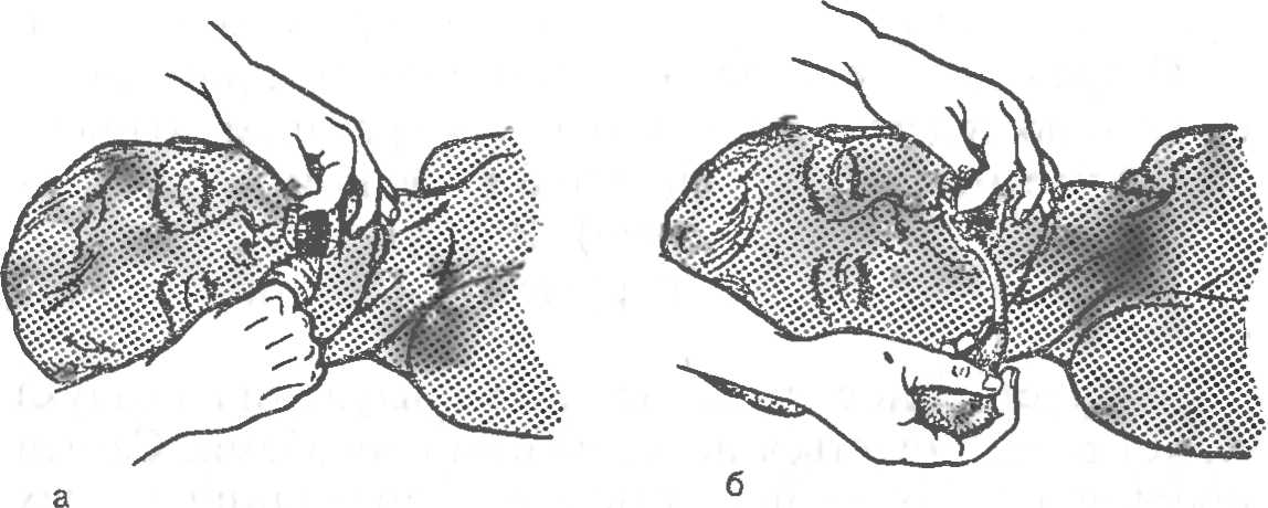 Рис. 18. Освобождение полости рта и глотки от инородных тел, слизи и рвотных масс.