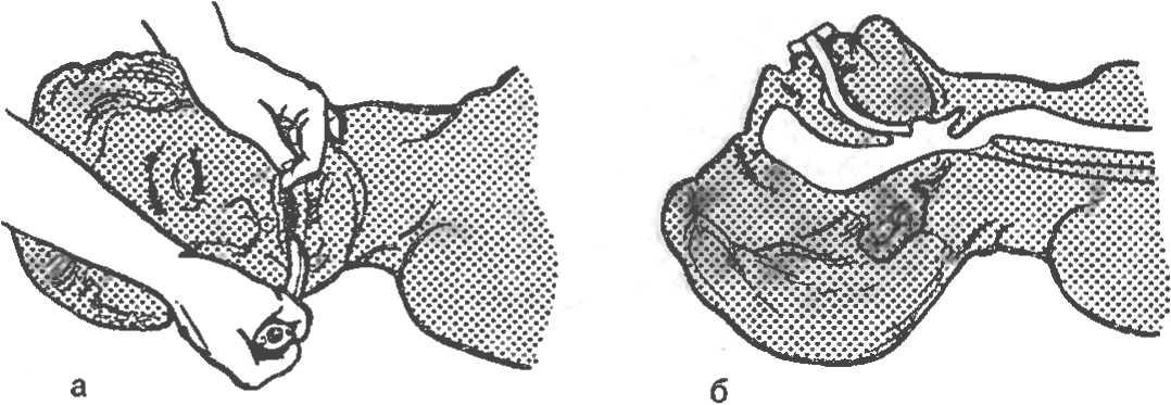 Рис. 20. Правильное введение воздуховода в ротоглотку (а) и схематическое изображение установленного воздуховода (б).