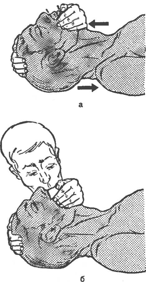 Рис. 21. Искусственная вентиляция легких методом рот в рот.