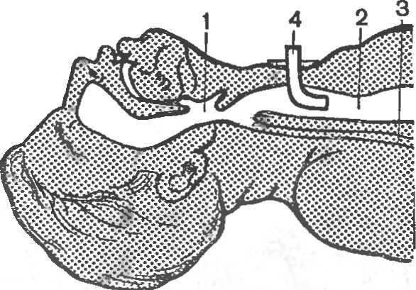 Рис. 24. Трахеостомия.